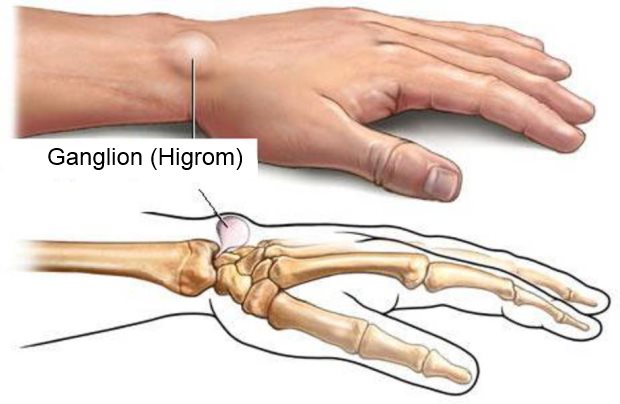 ganglion higrom