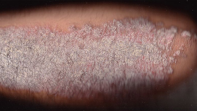 psorijaza