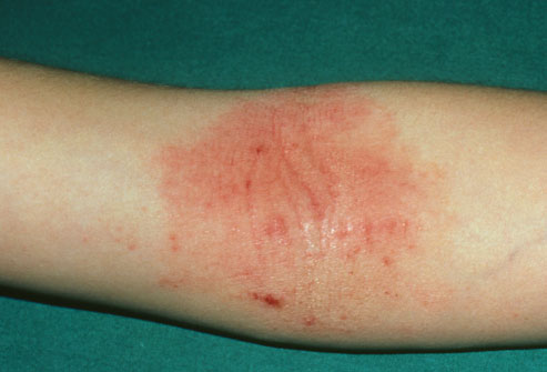 atopijski dermatitis i alergije