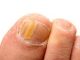 gljivicna infekcija noktiju