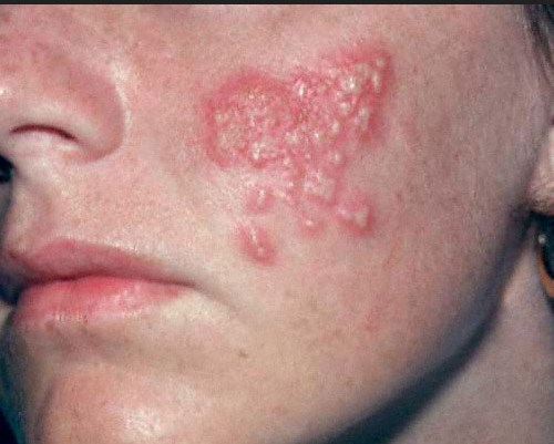 herpes na licu
