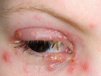 ocni herpes