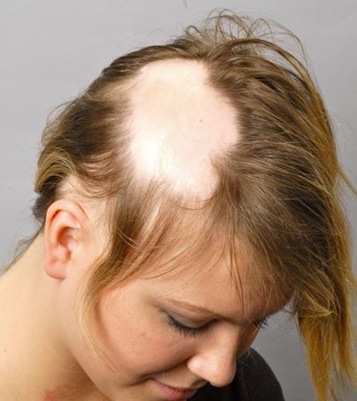 alopecija kod zena