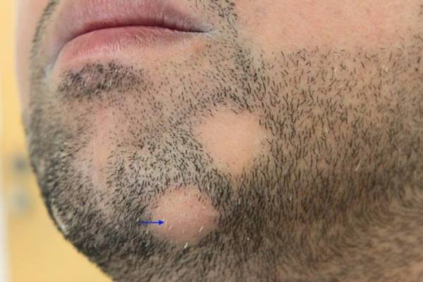 alopecija na bradi