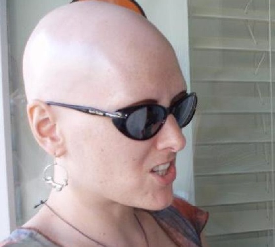 alopecija univerzalis