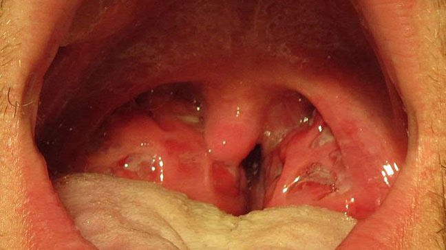bakterije u grlu