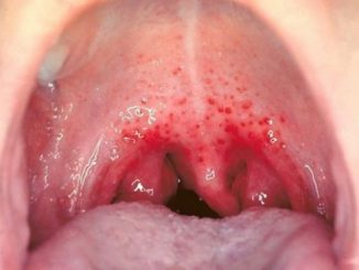 herpes u ustima