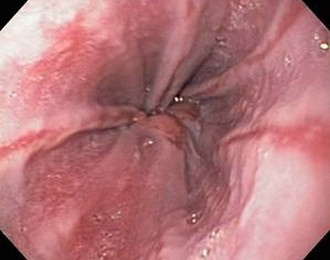 erozivni ezofagitis