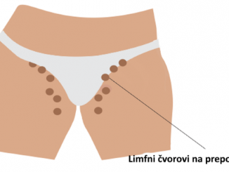 limfni cvorovi na preponama