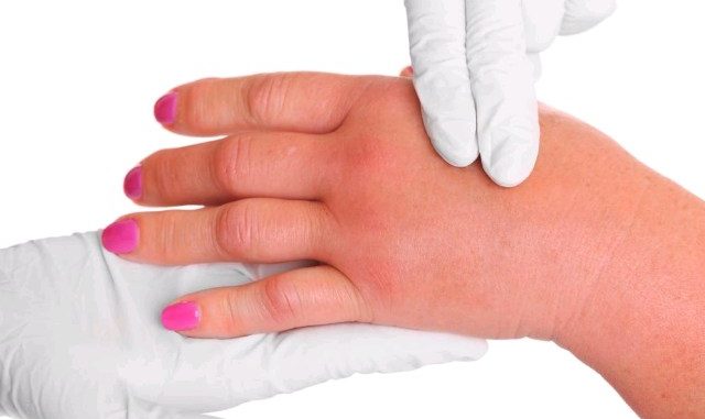 bolovi u zglobovima i oticanje ruku lijekove i liječenje osteoartritisa