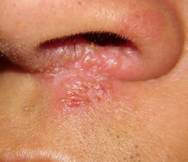 stafilokoka bakterija u nosu