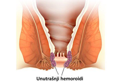 unutrasnji hemoroidi