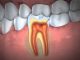 zubna gangrena