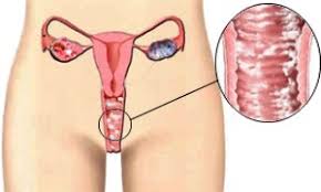 vaginalna kandida