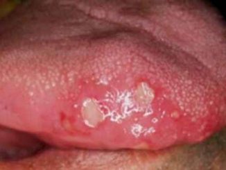 herpes jezika