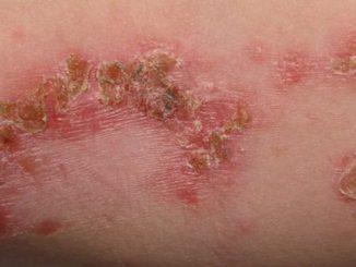 impetigo