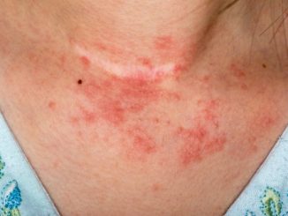 kontaktni dermatitis