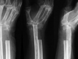 osteomijelitis