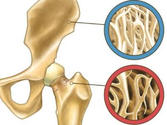 osteopenija