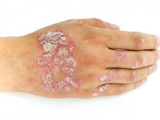 psorijaza