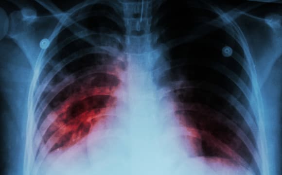 tuberkuloza pluca