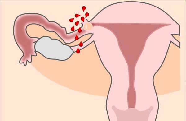 vanmatericna trudnoca simptomi